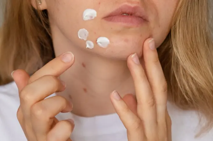 Timbulnya Jerawat Akibat Penggunaan Pelembap